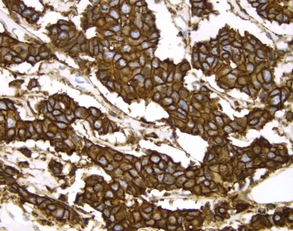 Breast Cancer: C-Erbb2 Oncoprotein Stained Using Vectastain Elite Abc Kit And Vector Dab (Brown) Substrate. Hematoxylin Qs (Blue) Counterstain.