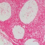 Tonsil: Anti-Cd45 (Rat Monoclonal), Immpress-Ap Anti-Rat Igg, Vector Red Substrate.