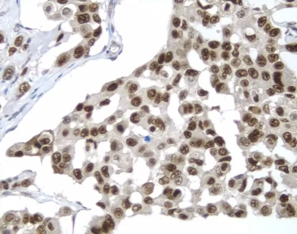 Breast: P53 (Rp), Immpress Anti-Rabbit Ig Kit, Dab Substrate Kit (Brown). Hematoxylin Qs Counterstain (Blue).