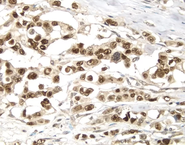 Breast Cancer: P53 Protein Stained Using Vectastain Elite Abc Kit And Vector Dab (Brown) Substrate. Hematoxylin Qs (Blue) Counterstain.