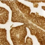 Prostate: Prostate Specific Antigen (M), Immpress Reagent (Hrp), Immpact Dab (Brown).
