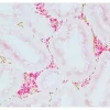 Colon Carcinoma (paraffin): ImmPRESS Duet Kit (MP-7724) used to detect mouse anti-CD34 (ImmPACT DAB, brown) and rabbit anti-Ki67 (ImmPACT Vector® Red, magenta) antibodies.