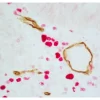 Colon Carcinoma (paraffin): ImmPRESS Duet Kit (MP-7724) used to detect mouse anti-CD34 (ImmPACT DAB, brown) and rabbit anti-Ki67 (ImmPACT Vector® Red, magenta) antibodies.