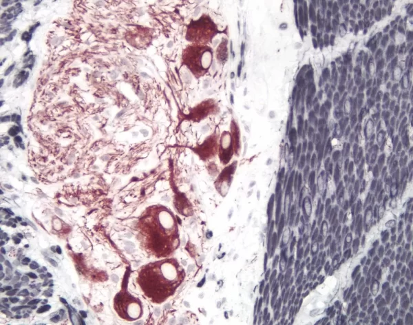 Small Bowel (Double Label): Peripherin (M), Immpress Anti-Mouse Ig Kit, Vector Novared (Red) Substrate. Desmin (M), Immpress Anti-Mouse Ig Kit, Dab/Ni (Black) Substrate.
