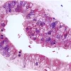 Colon Cancer: Anti-Ki67 (rabbit mab), ImmPRESS-AP Anti-Rabbit IgG, Vector Blue Substrate (blue); Anti-Cox2 (rabbit mab), ImmPRESS-AP Anti-Rabbit IgG, ImmPACT Vector Red Substrate (red).