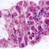 Colon Cancer: Anti-Ki67 (rabbit mab), ImmPRESS-AP Anti-Rabbit IgG, Vector Blue Substrate (blue); Anti-Cox2 (rabbit mab), ImmPRESS-AP Anti-Rabbit IgG, ImmPACT Vector Red Substrate (red).