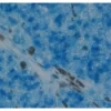 Melanoma: Anti-Vimentin (rabbit mab), ImmPRESS-AP Anti-Rabbit IgG, Vector Blue Substrate (blue).