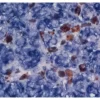 Melanoma: Anti-Vimentin (rabbit mab), ImmPRESS-AP Anti-Rabbit IgG, BCIP/NBT Substrate (indigo).