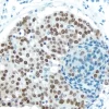Breast Carcinoma: Estrogen receptor (rm), ImmPRESS Anti-Rabbit Ig Kit, DAB (brown) substrate. Hematoxylin QS (blue) counterstain.