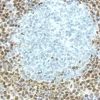 Breast Carcinoma: Estrogen receptor (rm), ImmPRESS Anti-Rabbit Ig Kit, DAB (brown) substrate. Hematoxylin QS (blue) counterstain.