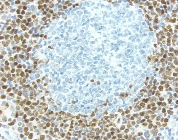 Breast Carcinoma: Estrogen Receptor (Rm), Immpress Anti-Rabbit Ig Kit, Dab (Brown) Substrate. Hematoxylin Qs (Blue) Counterstain.
