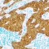 Tumor: Cytokeratin 18 (sheep), VECTASTAIN Elite ABC Kit for Sheep IgG, Vector DAB (brown), Vector Methyl Green counterstain (green).