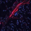 Colon Carcinoma (FFPE) was antigen retrieved with Antigen Unmasking Solution and stained with DyLight 594 labeled UEA I. Mounted in VECTASHIELD HardSet Mounting Medium with DAPI.