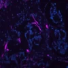 Colon Carcinoma (FFPE) was antigen retrieved with Antigen Unmasking Solution and stained with DyLight 649 labeled UEA I.