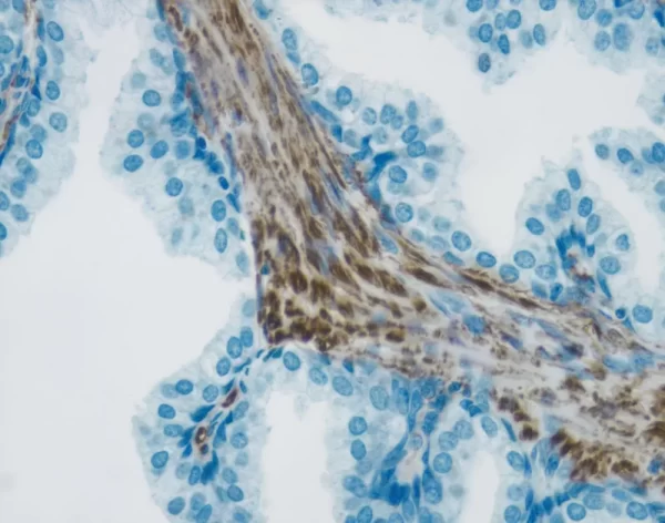 Tumor Tissue Section Showing Specific Cytoplasmic Cell Staining (Brown, Vector Dab) With Vector Hematoxylin Qs (Blue) Counterstain.