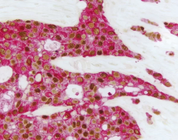 Breast Carcinoma (Double Label): Estrogen Receptor (M), Immpress Universal Reagent, Vector Dab Substrate (Brown); Multi-Cytokeratin (M), Vectastain Universal Abc-Ap Kit, Vector Red Substrate (Red).