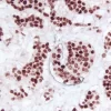 Breast Carcinoma (double label): Estrogen Receptor (rm), ImmPRESS Universal Reagent, Vector NovaRED substrate (red); M2A Antigen (m), ImmPRESS Universal Reagent, DAB+Ni substrate (gray/black).