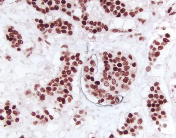 Breast Carcinoma (Double Label): Estrogen Receptor (Rm), Immpress Universal Reagent, Vector Novared Substrate (Red); M2A Antigen (M), Immpress Universal Reagent, Dab+Ni Substrate (Gray/Black).