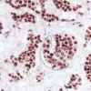 Breast Carcinoma (double label): Estrogen Receptor (rm), ImmPRESS Universal Reagent, Vector NovaRED substrate (red); M2A Antigen (m), ImmPRESS Universal Reagent, DAB+Ni substrate (gray/black).