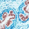 Breast Carcinoma (double label): Estrogen Receptor (m), ImmPRESS Universal Reagent, Vector NovaRED substrate (red); CD34 (m), VECTASTAIN Universal ABC-AP kit, Vector Blue substrate (blue).