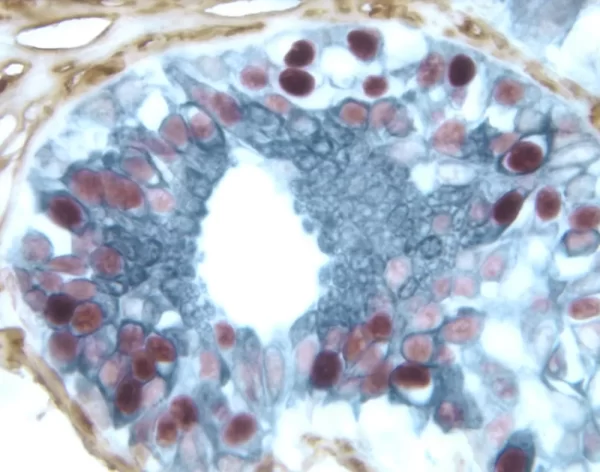 Breast Carcinoma (Triple Label): Estrogen Receptor (M); Vectastain Elite Abc Kit, Vector Novared Substrate (Red); Cd34 (M), Vectastain Elite Abc Kit, Dab Substrate (Brown); Cytokeratin 8/18 (M), Vectastain Elite Abc Kit, Vector Sg Substrate (Blue/Gray).