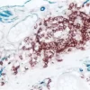Colon (double label): CD34 (m), VECTASTAIN Universal ABC-AP Kit, Vector Blue substrate (blue); CD20 (m), ImmPRESS Universal Reagent, Vector NovaRED substrate (red).