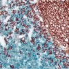 Tonsil (double label): CD3 (m), VECTASTAIN Universal ABC-AP Kit, Vector Blue substrate (blue); CD20 (m), ImmPRESS Universal Reagent, Vector NovaRED substrate (red).