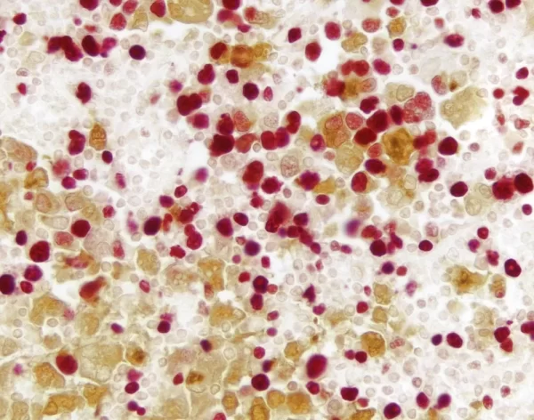 Lymph Node (Double Label): Ki67 (M), Vectastain Universal Abc-Ap Kit, Vector Red Substrate (Red); Multi-Cytokeratin (M), Vectastain Universal Elite Abc Kit, Dab Substrate (Brown).