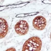 Colon (double label): M2A Antigen (m), ImmPRESS Universal Reagent, DAB+Ni substrate (gray/black); Cytokeratin 8/18 (m), ImmPRESS Universal Reagent, Vector NovaRED substrate (red).