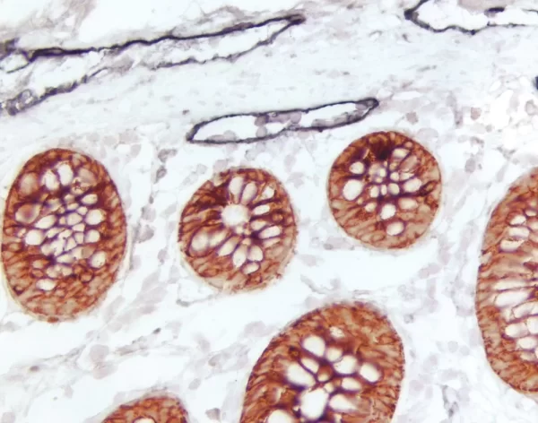 Colon (Double Label): M2A Antigen (M), Immpress Universal Reagent, Dab+Ni Substrate (Gray/Black); Cytokeratin 8/18 (M), Immpress Universal Reagent, Vector Novared Substrate (Red).