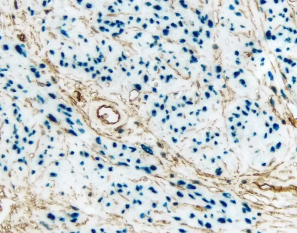 Endometrium (Double Label): Progesterone Receptor (Rm), Vectastain Universal Abc-Ap Kit, Vector Blue Substrate (Blue); Cd34 (M), Vectastain Universal Elite Abc Kit, Dab Substrate (Brown).