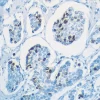 Human Breast Carcinoma: Ki67 (m), VECTASTAIN Universal Quick Kit with DAB (brown) substrate. Hematoxylin (blue) counterstain.