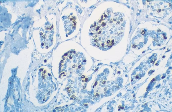 Human Breast Carcinoma: Ki67 (M), Vectastain Universal Quick Kit With Dab (Brown) Substrate. Hematoxylin (Blue) Counterstain.