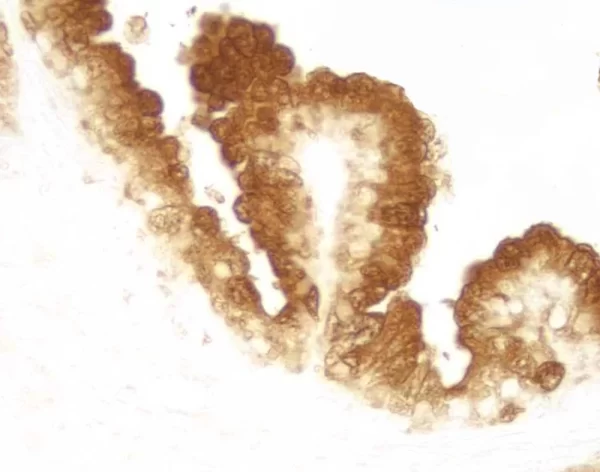 Paraffin Embedded Human Prostate Tissue Stained Using Rabbit Anti-Prostate Specific Antigen (Psa) Detected With Vectastain Elite Abc Reagent And Vector Dab Substrate.